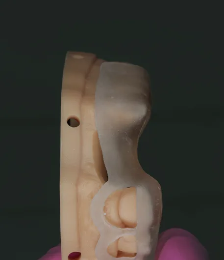 Crown Lengthening Guides