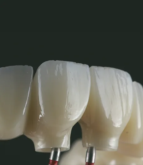 Full Arch Implant Restorations