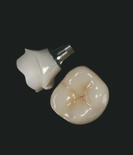 Implant Crowns