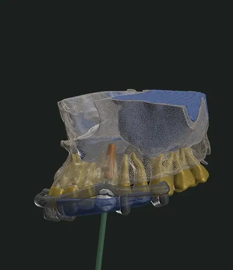 Implant Planning and Surgical Guides
