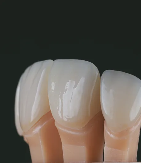 Veneers