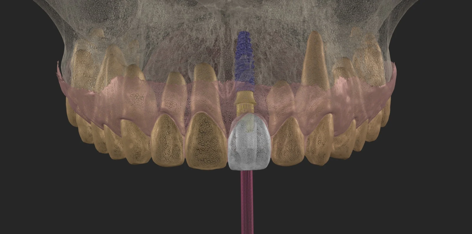 Digital Implant Planning and Surgical Guides: Precision-Driven Implantology with Zenith Dental Labs