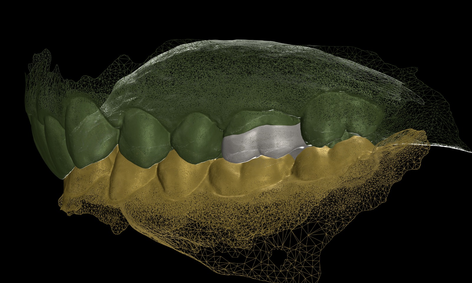 Digital Dental Impressions: Elevating Accuracy, Efficiency, and Collaboration in Modern Dentistry