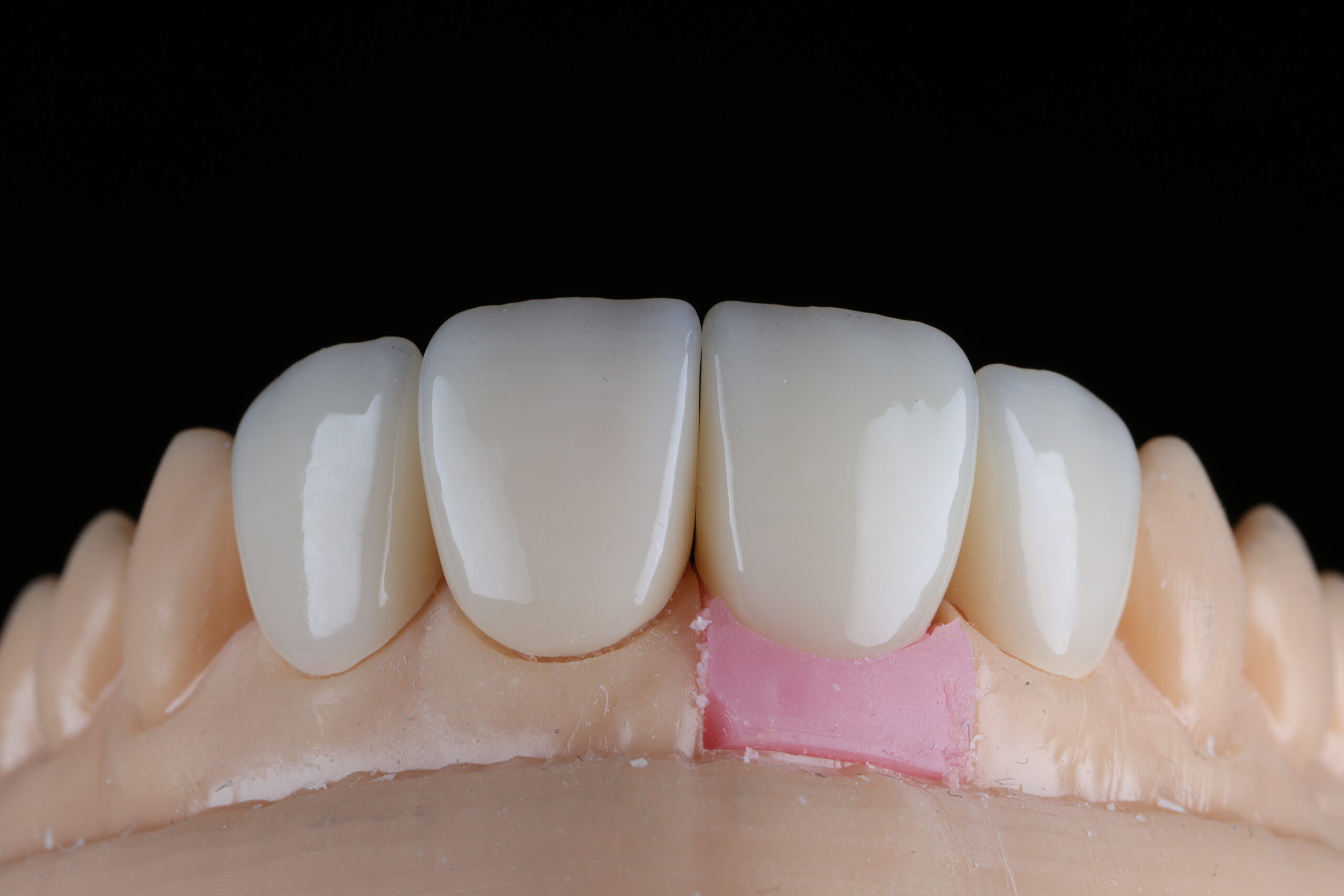 **Alt text:** Dental model showing four anterior crowns with pink gingival material beneath one central incisor, illustrating crown and soft tissue contouring in a prosthetic restoration.