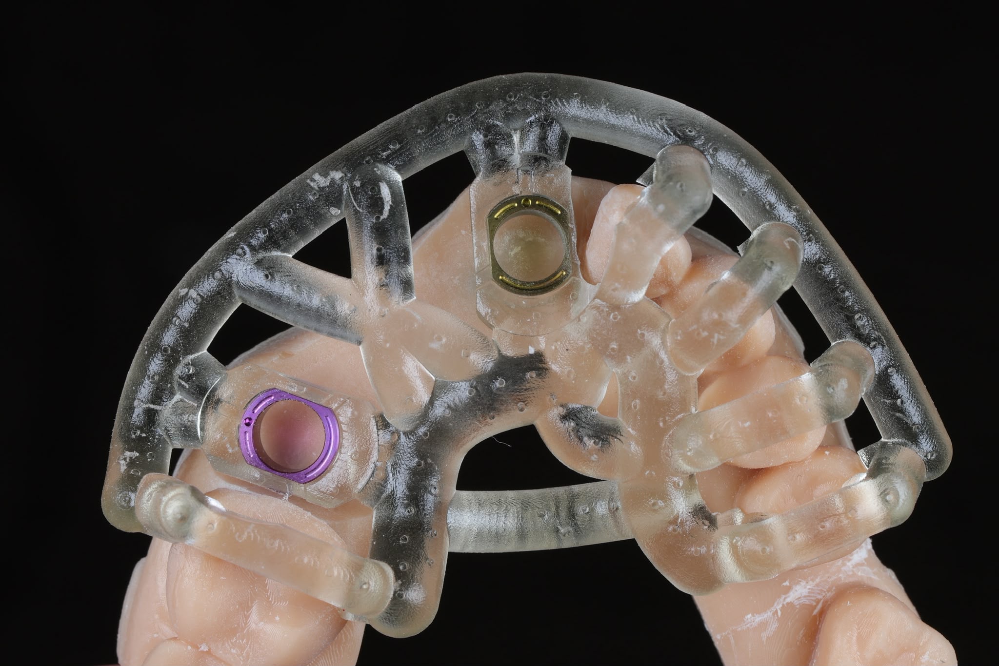 Immediate Temporisation with Surgical Guides: Planning the Provisional Before the Patient Leaves the Chair