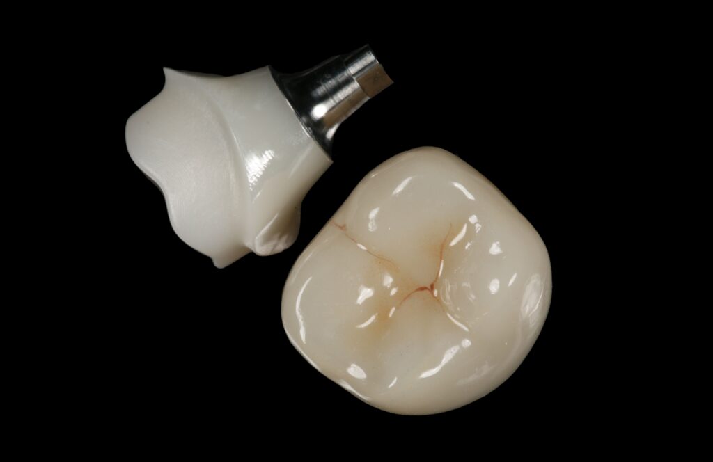 cement-retained zirconia implant crown on hybrid abutment