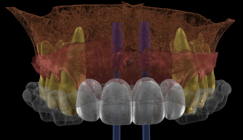 3D digital implant planning model showing implant positions, teeth, soft tissue, and proposed restorations for guided implant treatment.
