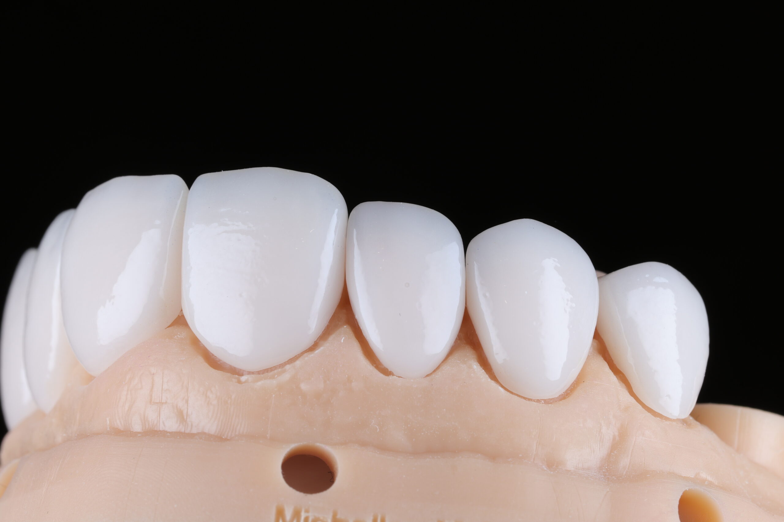 Veneers: Feldspathic vs Pressed vs Composite — A Lab Guide to Material Selection
