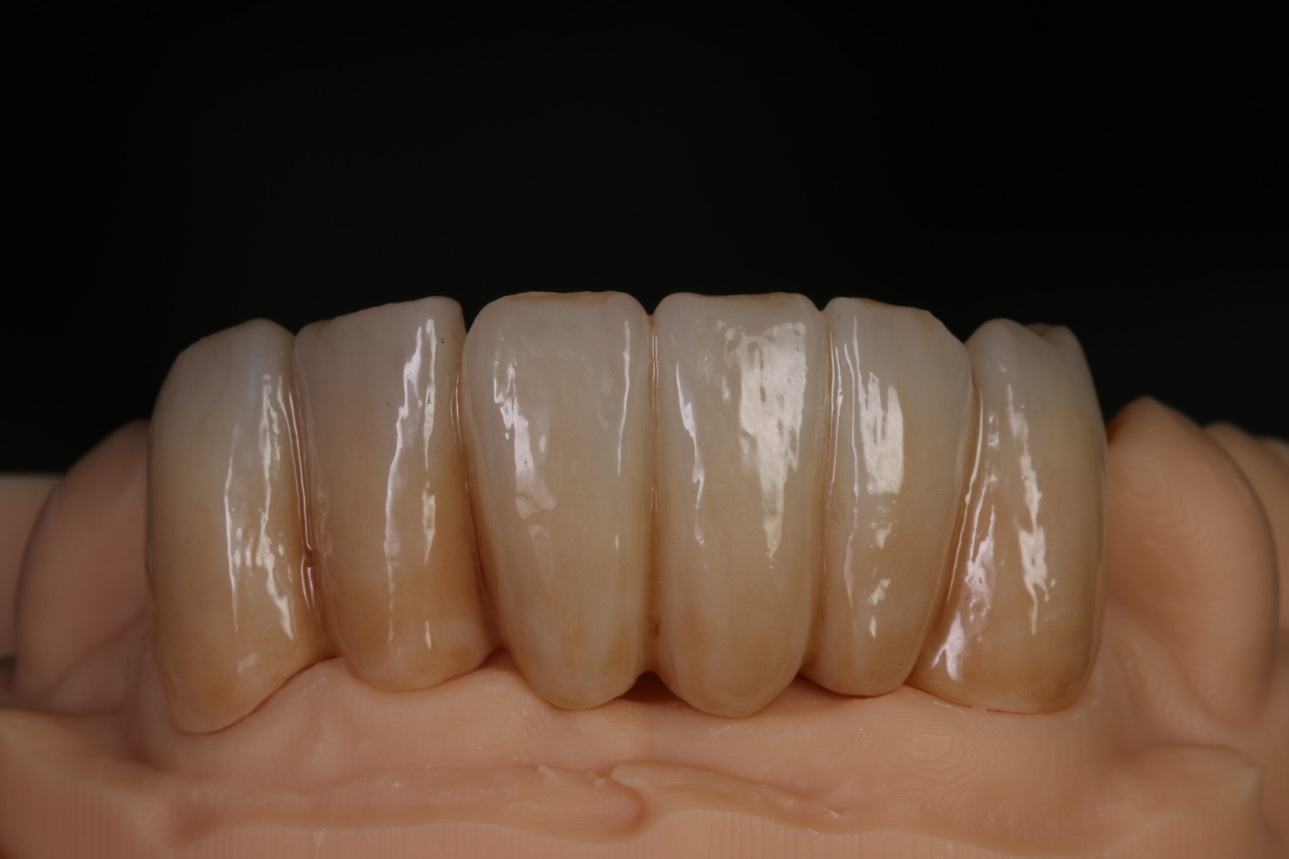 Dental Bridges: Types, Materials and Design — A Restorative Guide