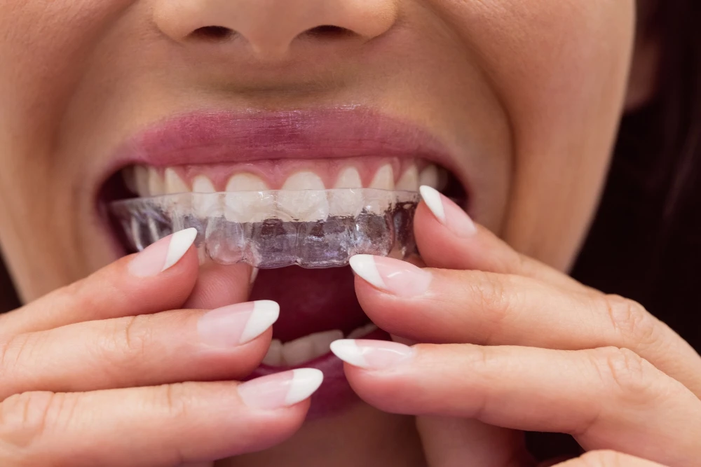 Dental Splints: the Types and When Each One Is Prescribed