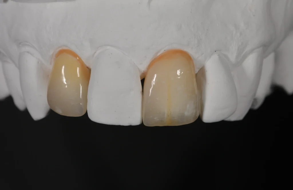 Dental Laboratory Price List: What Actually Drives the Cost of Lab Work