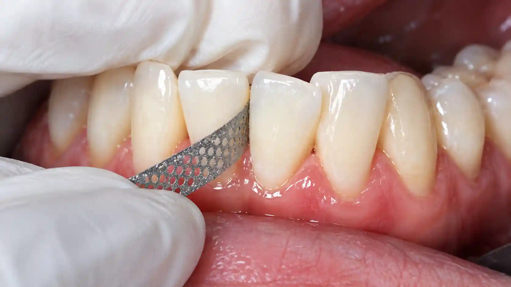 Interproximal reduction strip between two teeth